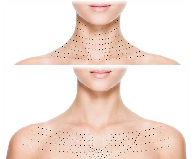 Marcação na pele do pescoço e decote para rejuvenescimento bio-revitalização