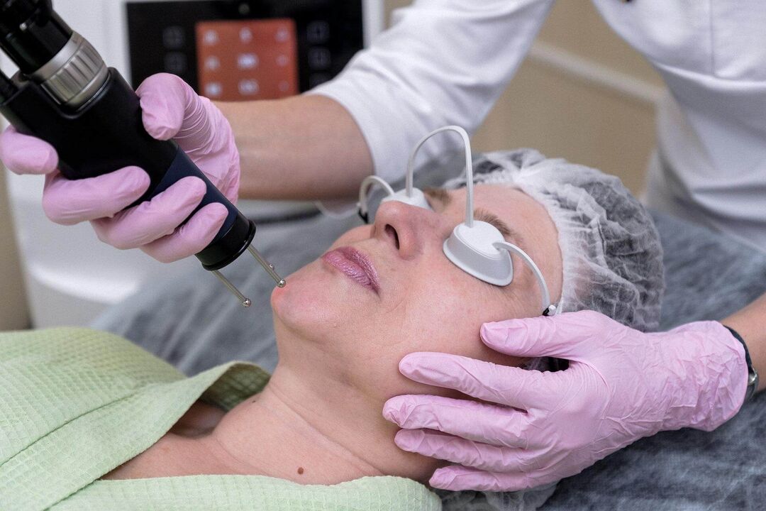 Procedimento de laser ablativo para rejuvenescimento da pele