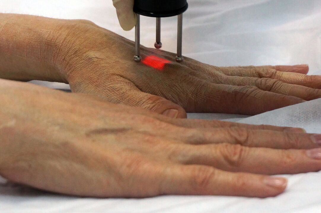 Rejuvenescimento a laser das mãos usando um método não ablativo
