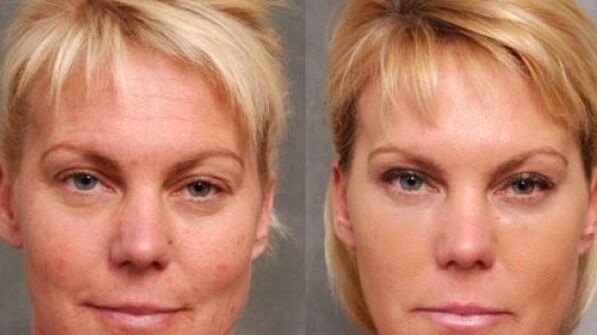 Antes e depois do procedimento de rejuvenescimento