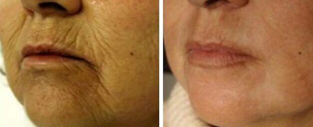 Rejuvenescimento 4d
