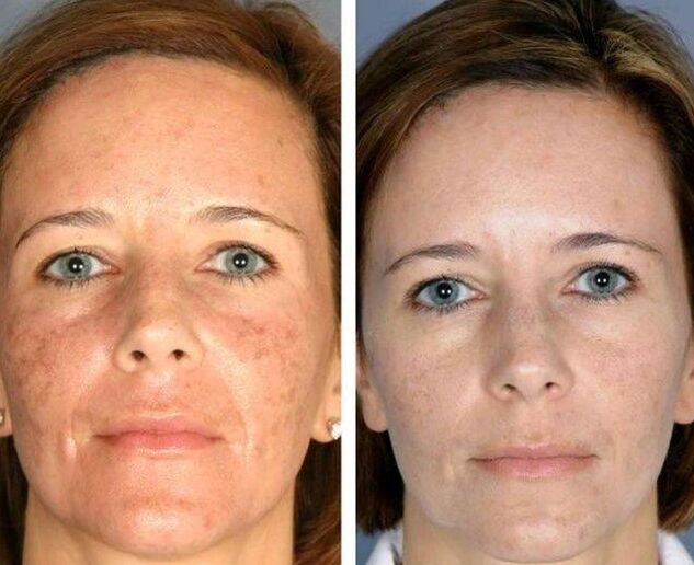 Rejuvenescimento a laser