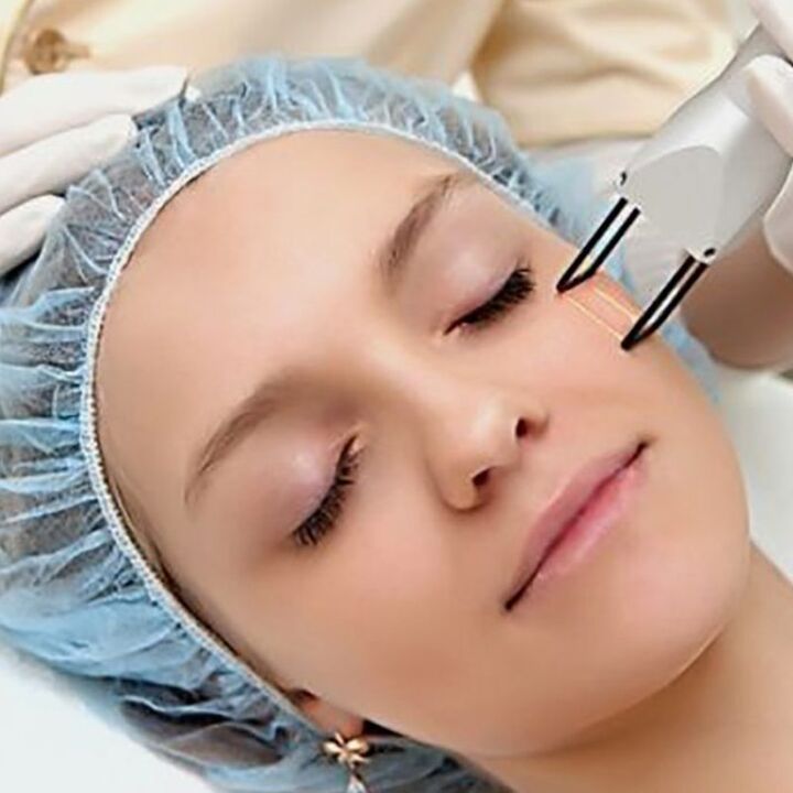 Rejuvenescimento fracionário a laser