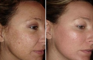 Rejuvenescimento facial a laser antes e depois das fotos